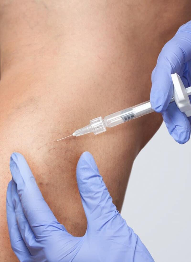 home-Sclerotherapy