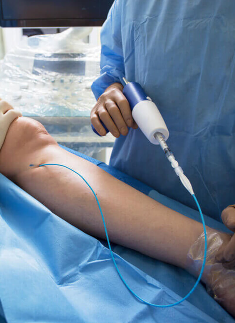 home-vein-sealing-glue